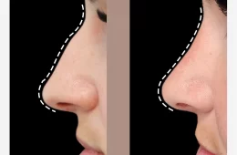 رینوپلاستی (جراحی زیبایی بینی) | تجربه، نکات علمی و مراقبتها