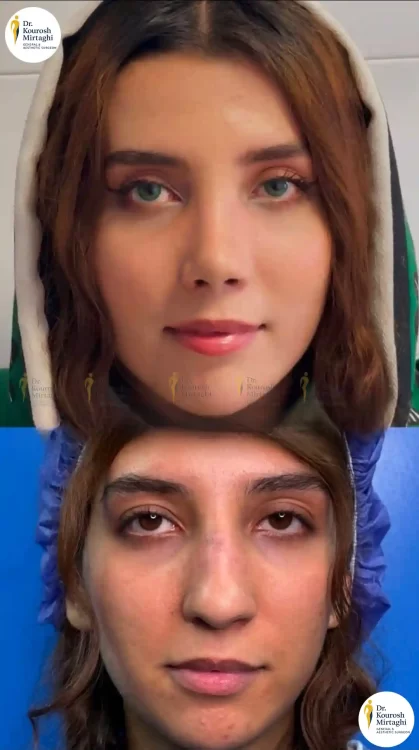 جراحی بینی(سپتورینوپلاستی)