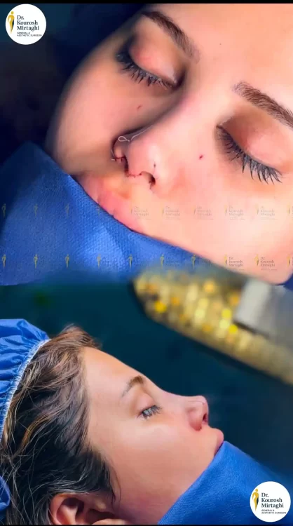 رینوپلاستی جراحی بینی