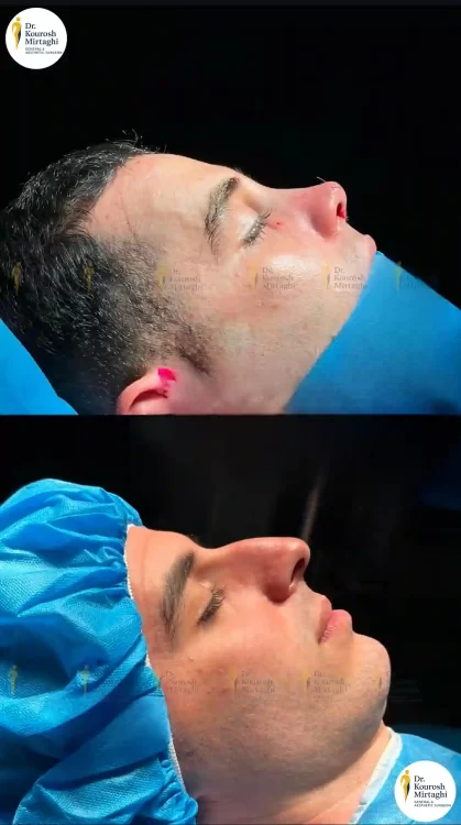 نمونه کار جراحی بینی